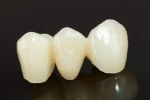 dental bridges fredericksburg