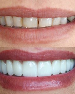 Cosmetic Bonding Westwood, Cosmetic Dentist